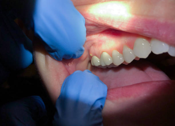 Best Emergency Root Canal Treatment in Creswell, OR